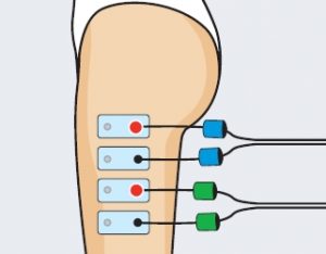 Colocacion electrodos cintilla iliotibial