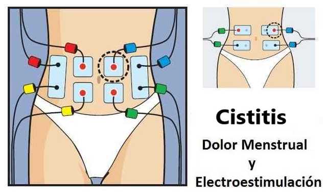 calmar molestias cistitis electroestimulación